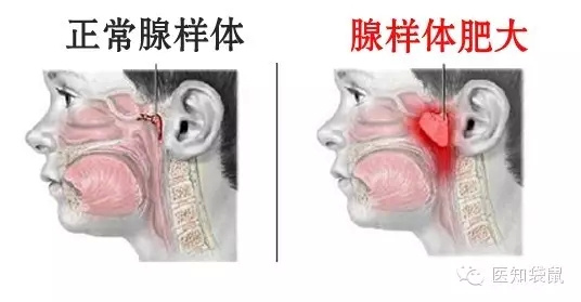 【组图】张嘴睡觉会越变越丑？看完你就知道了