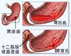 j2开奖直播:【j2开奖】胃溃疡真的是由“饮食不规律”引起的吗？