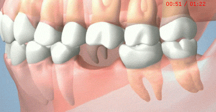 军医科普：缺牙的类型