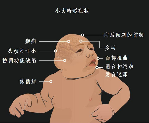 本港台直播:【j2开奖】孕妇感染寨卡病毒，胎儿可致小头畸形；本港台直播国已出现寨卡病毒感染病例，其中75%无症状