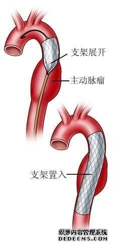 新桥医院心内科成功为主动脉夹层孕妇施行封堵术