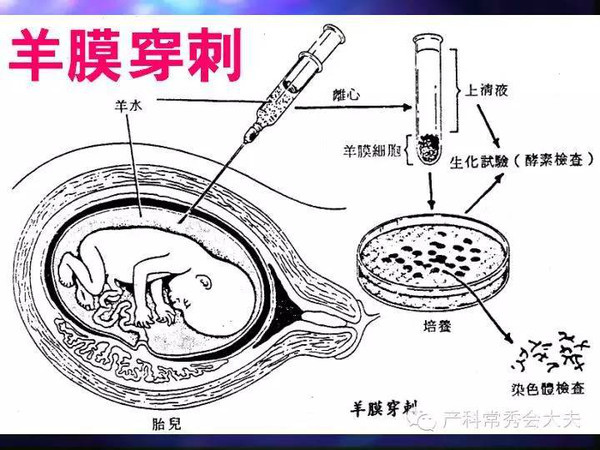 j2开奖直播:【j2开奖】唐氏综合征筛查检测手段大PK