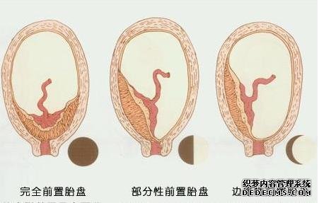 第306医院妇产科成功抢救一例胎盘早剥