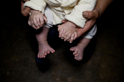 3个月大男婴患“多指症” 遗传妈妈手脚加起来共有31根