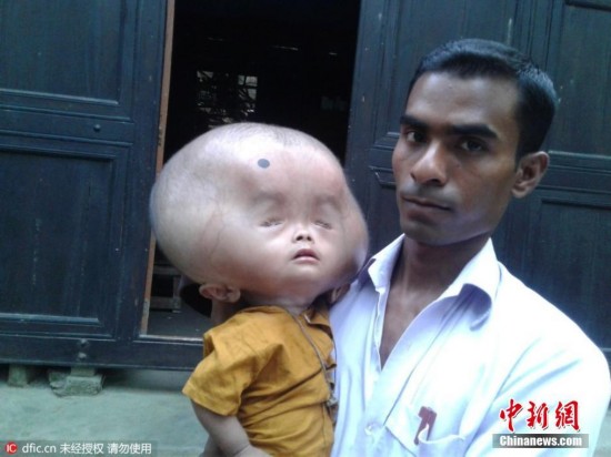 5月26日消息，孟加拉国2岁小男孩Emon头重20磅(约18斤)并还在继续生长。Emon出生是剖腹产，生下来脑袋就比常人要大。自开奖直播出生后，开奖直播的脑袋就不断生长。看着患病的儿子，Emon的爸爸和妈妈竭尽一切力量，走访各个村庄为Emon寻医问药。但是，没有一个人能告诉Emon的父母，Emon究竟患的是什么病。