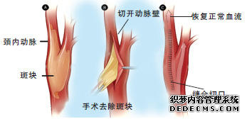 军医解读：何为颈动脉“斑块”