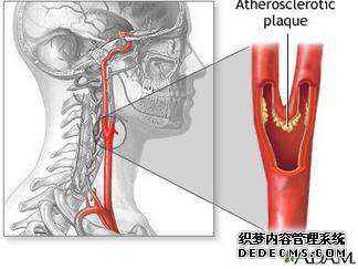 军医解读：何为颈动脉“斑块”