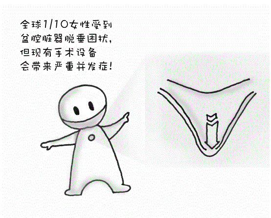 码报:【j2开奖】全球1/10女性受到盆腔脏器脱垂困扰