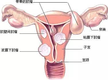 【j2开奖】每4个女人中就有1个有子宫肌瘤，这瘤子到底多可怕？