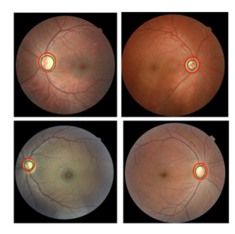 wzatv:【图】继 DeepMind 致力眼疾后，IBM 的认知计算能诊断 95% 的早期青光眼