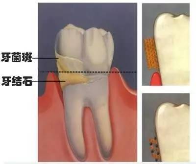 报码:【j2开奖】一颗牙结石引发的震惊：我们的祖先，被尼安德特人kiss过！